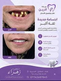 ✅ تعويض الأسنان المفقودة ✅ تركيبات ثابتة بأفضل الخامات ✅ تحسين الشكل ا...
