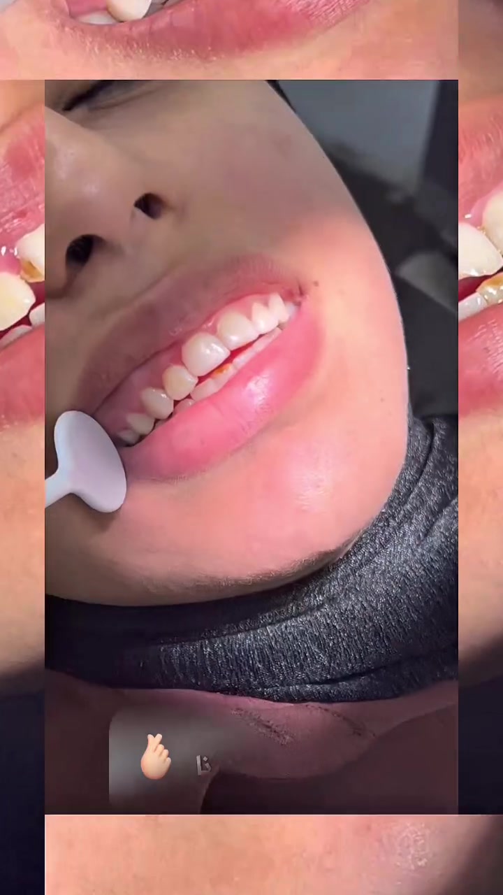جزء من شغلنا اليومي ✨
وهاي واحدة من الـ10 حالات اللي نستقبلها يوميًا

حشوة تجميلية ترجعلك ابتسامتك الطبيعية
بجلسة وحدة فقط ⏱️
بدون ألم… وبدون تعقيد

والأهم؟
سعر مناسب يخليك ما تأجل العلاج بعد اليوم 💫
راسلنا واحجز موعدك اليوم 
ابتسامتك تستاهل تهتم بيها 💕
 #اكسبلور  #بغداد #حشوات تجميلية  #explore
 #فولو


**إذا كنت صاحب هذا الإعلان وتريد حذفه لأي سبب، رجاءا أرسل رسالة إلى الدعم الفني**
