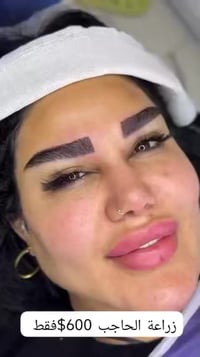"عمليه زرع حاجب ✨🤍🤍🤍🤍🤍  بأشراف افضـل اطـباء الجراحة والتجـميل ________...