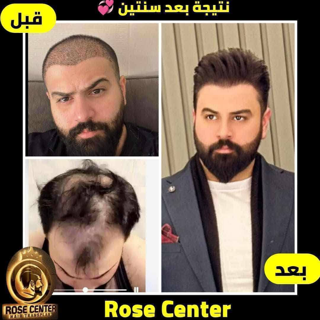 معكم الاستشارية طبيه يسر
تحب تزرع لا تحتار كلينك روز اقدم وارقي مركز بغداد كثافة وشكل مميز مرتب مع شهادة ضمان

واني اسويلك معاينه مضبوطة واتابع حالتك طول فترة الزراعة 🩵🌷

فقط اتصل

***********

متوفر واتساب 👆
