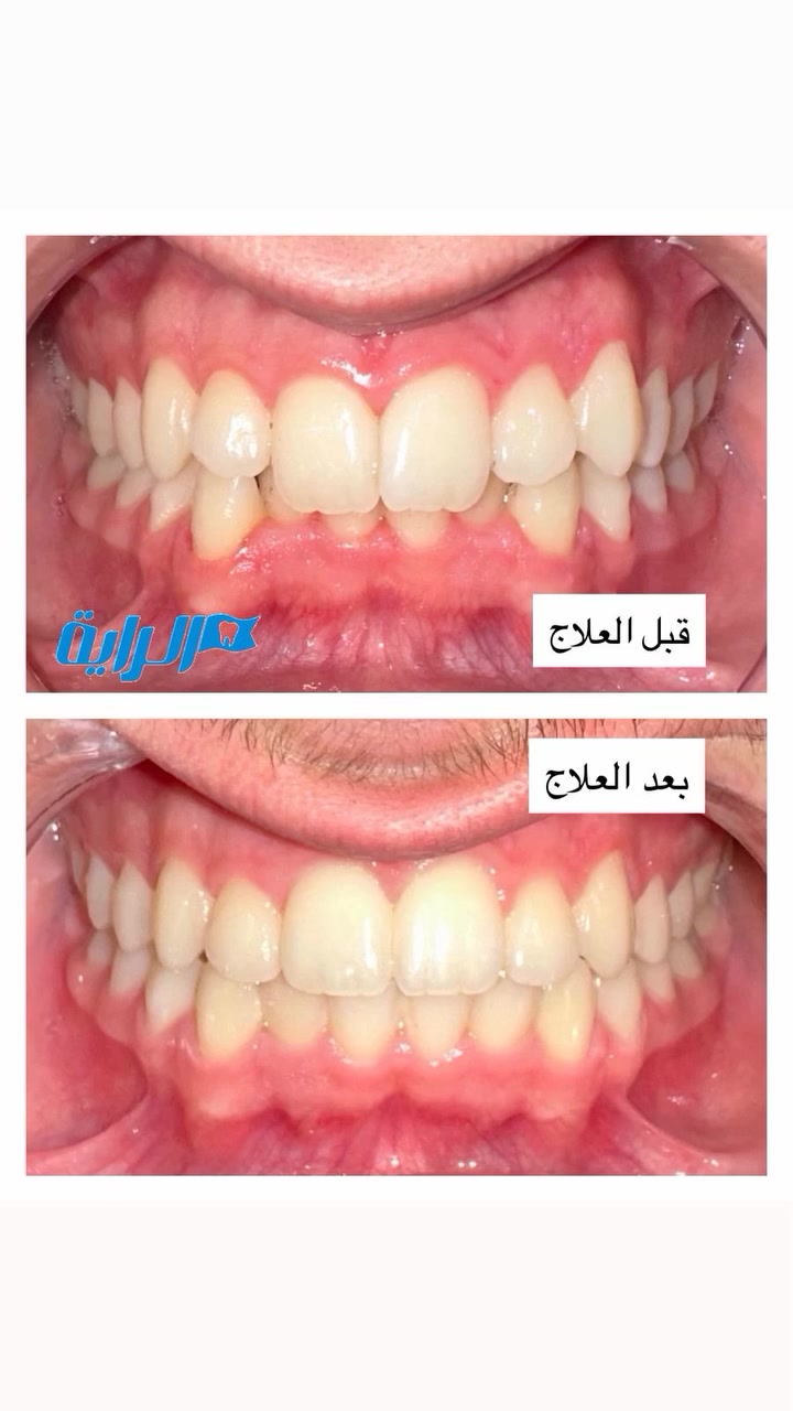 #عياده #الرايه #لطب #الاسنان
🦷 الابتسامة الحلوة مو بس تغيّر شكلك...
تغيّر ثقتك بنفسك هم. ✨🤍

خلّي ابتسامتك تحچي عنك.


**إذا كنت صاحب هذا الإعلان وتريد حذفه لأي سبب، رجاءا أرسل رسالة إلى الدعم الفني**