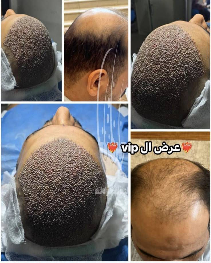 💥احدث تقنيات زراعة الشعر بعيادة بغداد .
💥بأدرة دكتور يونس البديري .

💥زراعة vib كامل التفاصيل علينه.

//للتواصل (***********)واتساب وتصال
