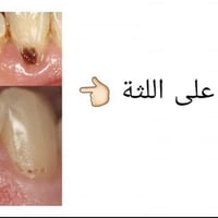 علاج أسنان • تسوس قرب اللثة • مجاناً