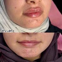 انقلاب الشفة • دكتورة نور رائد • عيادة بيرلي الحمزة الشرقي