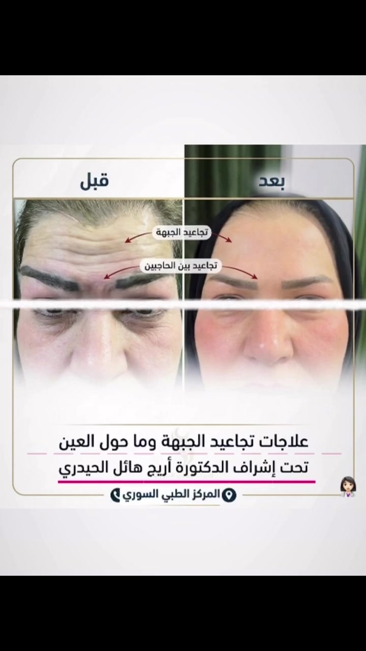 المركز السوري الطبي 
😍😍😍 😍😍😍نتيجه حقن البوتوكس لتجاعيد مابين الحاجب والجبهه وماحول العينين   💉🥼🩵 
كافة خدمات التجميل متوفرة بمركزنا ( للنساء والرجال )
وتحت أيادي أطباء اختصاص
متواجدين كل أيام الأسبوع 
المعاينة مجانا

الدكتورة اريج هائل الحيدري ❤️❤️
#فلر #مدينة_الصدر #المحمودية
#المركز_السوري_الطبي
العنوان المحمودية تقاطع العزاب(المجمع) قرب مقر الفوج الثاني سابقاََ
للحجز والاستفسار مراسلة الصفحة أو الاتصال على الأرقام التالية 📱*********** ***********
