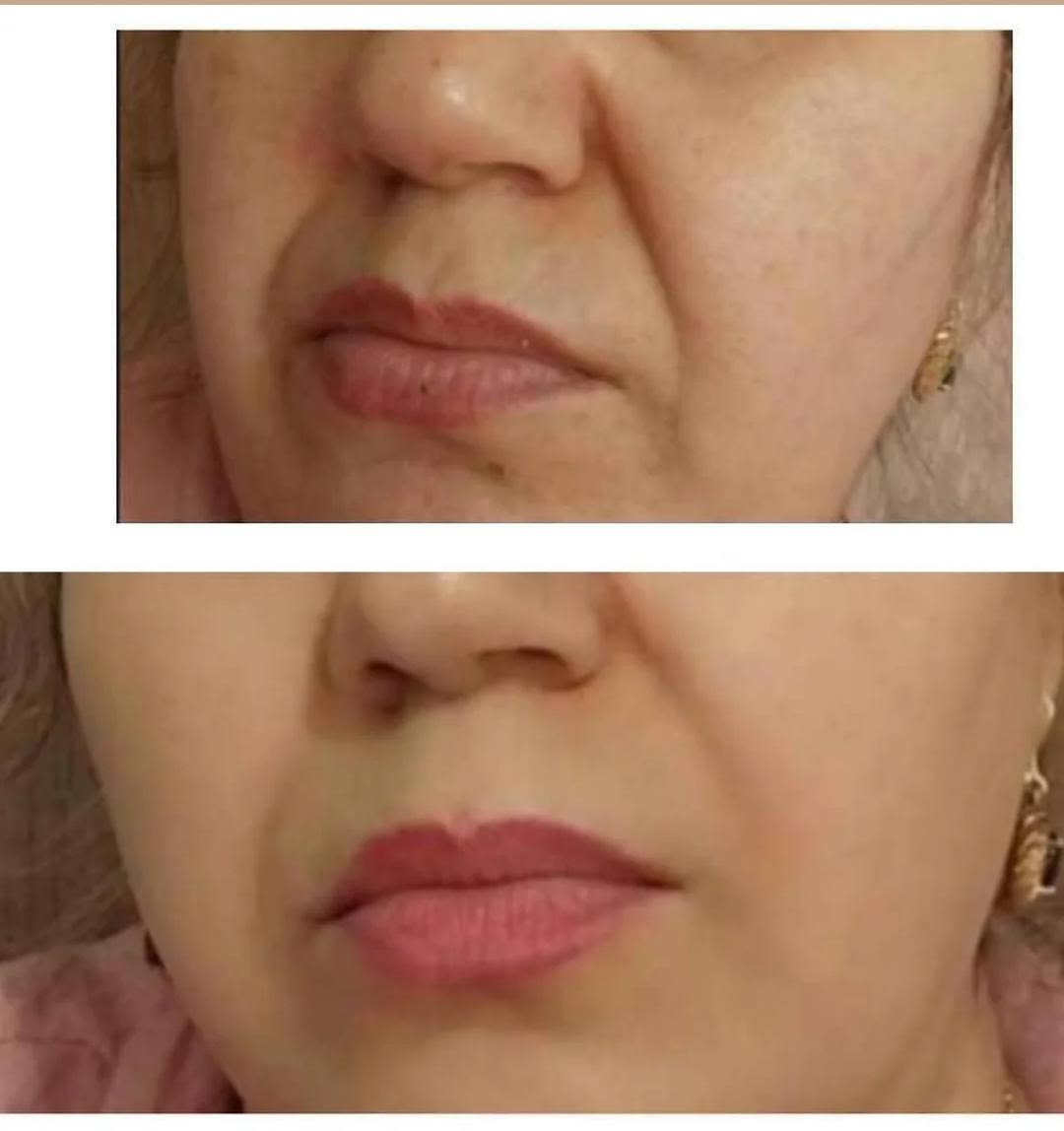 نتيجه احد زباين  كان عمر زبونه 45@ سیروم جل لیدوراکر مضاد للتجاعيد لبشرة الوجه، يحتوي على تركيبات فعّالة تُساهم في تقوية البنية الجلدية وزيادة مرونة البشرة. هذا السیروم جل يُحفّز إنتاج الكولاجين والإيلاستين، مما يجعل البشرة أكثر تماسكاً، شباباً وانتعاشاً. الإستخدام المنتظم لهذا السیروم جل لا يُحسّن مظهر البشرة فحسب، بل يساعد أيضاً في منع ترهّلها و إرتخائها.

 الميزات :
الوقاية من الشيخوخة المبكرة للبشرة، إزالة التجاعيد والخطوط الرفیعة، مضاد أكسدة قويه للغاية، شدّ البشرة، تقليل البقع الجلدية


**إذا كنت صاحب هذا الإعلان وتريد حذفه لأي سبب، رجاءا أرسل رسالة إلى الدعم الفني**