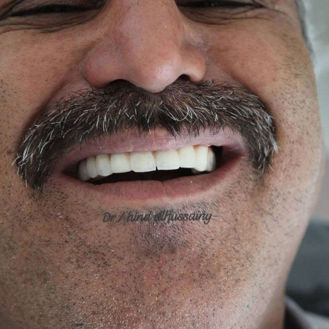 🦷 ابتسامة  بتصميم طبيعي، لون متناسق، ونتيجة تعزز الثقة بكل ابتسامة.
إذا كنت تبحث عن ابتسامة مرتبة وطبيعية تناسب ملامحك، فهذا هو الوقت المناسب.
زوروا عيادتنا
الامين الثانيه /النواب/شارع المهداوي مقابل عيادة النبأ

📩 للحجز والاستفسار راسلونا على ***********، والمواعيد محدودة.
