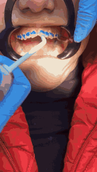 اذا كنت تعاني من العضه المفتوحة او ميلان بالاسنان ☹️

فتقويم الاسنان هوه العلاج المناسب 🤎😍

وبأحدث التقنيات وبدون الم

 كل خدمات طب الأسنان تحت سقف واحد وبنظام الاقساط على بطاقة كي كارد المصرفية 🥰🪪🪪

📞 احجز موعدك الآن وابدأ أول خطوة نحو ابتسامة جديدة🔥🔥
_____________________
للاستفسار التواصل خاص 
او الاتصال على الرقم/واتساب 📱☎️
*********** 
العنوان الحرية شارع المشجر مجاور الضريبة مقابيل مرطبات الساقي 
#الحرية_الاولى #مدينة_الحريه_الحبيبه #الحرية_شارع_باتا #الحرية_شارع30 #اكسبلور #تقويم_الأسنان #الحريه_ #تقويم_الأسنان #الحريه_ #التقويم_الشفاف✨ #تقويم_الأسنان #عياده_هايجنك_تهتم_بصحه_اسنانكم #الحريه_ #زراعه_الأسنان
