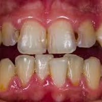 علاج التسوس • أسنان أمامية • النجف الاشرف