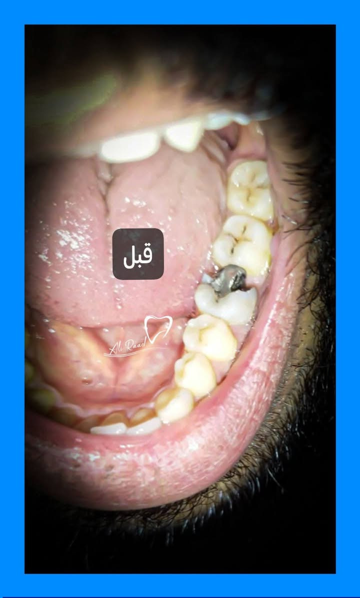 مجانا ..مجانا
سلام عليكم الي اسنانه بيهن تسوس ويريد يعالجهن..
متوفر حشوات ضوئية في عيادات كلية طب الأسنان جامعة بابل 
لحجز موعد ..علِّق وأرد عليك.
او الاتصال ***********
