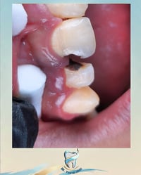 علاج قواطع أمامية • حشوات تجميلية • مجمع النورين
