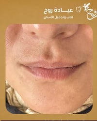 عيادة روح • فيلر شفايف • المحمودية
