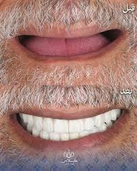 طقم اسنان • مجاني • جامعة المستقبل