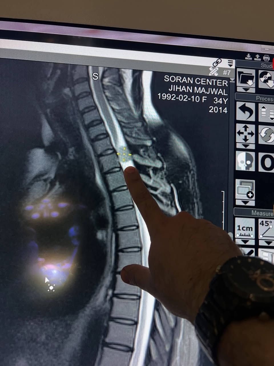 لله الحمد بفضل الله تعالى تم اجراء عملية مستعجلة بالمجهر الجراحي في الحبل الشوكي للمريضة تعاني من شلل كلي في كلا الساقين بسبب وجود ورم في الفقرة الصدرية الاولى مسببةً ضغطاً على الحبل الشوكي حيث استعادة المريضة القدرة على الحركة في كلا الساقين خلال ايام بعد العملية .
#الدكتور عيادة دكتور مكرم نورالدين مسرهد جراحة الدماغ والفقرات 
#مجمع الكندي الطبي الحويجة ☎️***********☎️
