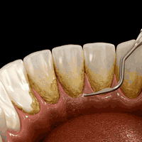 سلام عليكم…
 طبيبة أسنان وأشتغل حاليًا على بحث عن الطقم الجزئي المتحرك، وتتوفر مقاعد لحالات أعالجها مجانًا وبسرية تامة دون ذكر أي معلومات شخصية.

ويوجد علاج مجاني لمختلف مشاكل الأسنان، بكل أمانة ودقّة وتحت اشراف أطباء أختصاص بكل حاله مرضيه ، وشغلي منشور مع شرح مفصل على صفحتي الشخصية  حتى تشوفون النتائج بنفسكم.

📍 بغداد – شارع مطار بغداد – مستشفى البيان
📞 ***********

إذا محتاج تعويض الأسنان المفقوده ، تنظيف وتبيض الأسنان ، حشوات تجميليه بيضاء  قلع أو أي علاج…
أهلاً وسهلاً، وتشرفني ثقتكم
