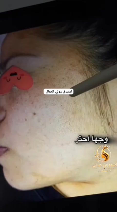 عروض محرم وصلت... والفرصة ما تتكرر! 

إذا تعانين من:  الحبوب / آثار الحبوب / المسام الواسعة  الرؤوس السوداء  /شحوب البشرة /وعدم توحّد اللون
فهذا المنتج يساعد على العناية بالبشرة، وتنظيفها، ويمنحها مظهراً أكثر نعومة وإشراقاً مع الاستخدام المنتظم، حتى تسترجعين نضارة بشرتج وثقتج بنفسج. 
🎁 وبمناسبة شهر محرم  خصومات مميزة 🎁 هدية مع الطلب ⏳ العرض لفترة محدودة فقط.
لا تنتظرين لين يخلص العرض، ابدئي رحلة العناية ببشرتج من هسه. 
📩 راسلينا الآن واحجزي طلبج قبل نفاد الكمية.


**إذا كنت صاحب هذا الإعلان وتريد حذفه لأي سبب، رجاءا أرسل رسالة إلى الدعم الفني**