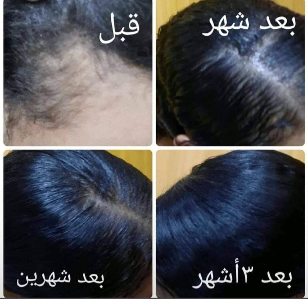 خلال سبوعين سبوعين لااكثر إذا مصار شعرج هيج أن بلخدمه
يطول شعر بشكل فضيع 😍✌️🏻

يمنعلج التساقط 

يكثف شعرج 

وينعمه ويلمعه شتريدين بعد أكثر سندوسه😉💜

يصير شعرج بطولج بالله العظيم 😍✌️🏻   دخذي واحد والثاني كد ماراح يعجبج الزيت غصب عليج راح ترجعين وتشترينه مني 🙊🥺😍وتوصيل لجميع محفظات 🚗🔥 بقيه البيجات عزلوا احسسلكم👍🏻❌

تعاي خاص ومعليج بل باقي توصيل جميع لمحفظات موجود لحجز ع خاص امنت الله ورسوله زيت مجرب وجربت ع شعري ومشالله نصحكم بيه كلش تاخذي تدعلي شرط ولله علفرق يشهدلله يجننن يجننن


**إذا كنت صاحب هذا الإعلان وتريد حذفه لأي سبب، رجاءا أرسل رسالة إلى الدعم الفني**