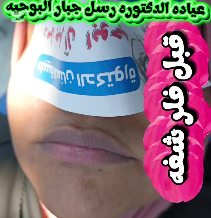 #قسم التجميل اللاجراحي في عياده الدكتوره رسل جبار البو حيه لطب الأسنان والتجميل .
 #فلر شفه قبل وبعد سيسي واحد فقط🍒

🔔دوام العياده كل يوم عصر من 2 لليل أما الجمعه دوام صبح وعصر🔔

♥الموقع: قضاء سومر _خلف اعداديه حلب للبنات بشارع الفرع العريض المقابل البلديه مباشرا. لتواصل واتساب
‏‪***********‬‏
‏‪***********‬‏
