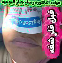 فيلر شفايف • دكتورة رسل جبار • قضاء سومر