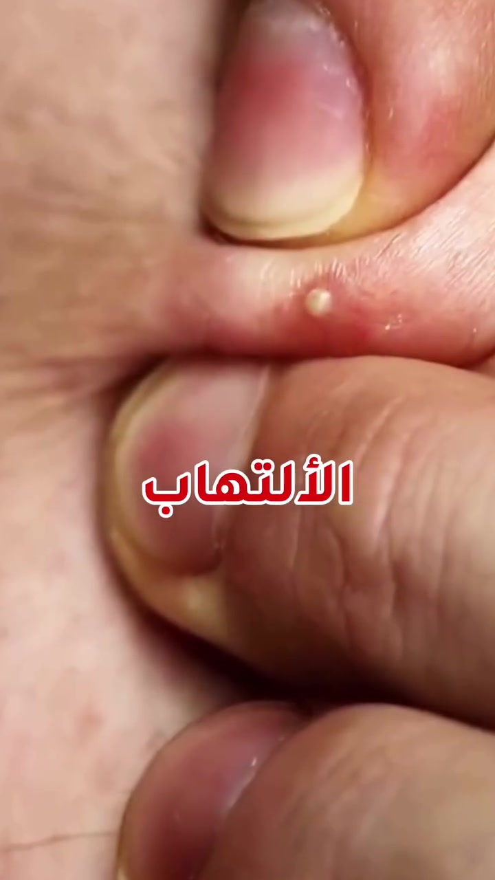 😳 أكثر البنات يفكرن الحبة تطلع فجأة… بينما الحقيقة؟ البشرة تعطي إنذار بالبداية 👀
إذا حسّيتي ألم صغير تحت الجلد أو حرارة بمكان معين لا تنتظرين الحبة تكبر 💔
كلما تدخلين أسرع… كلما خف الالتهاب وآثار الحبوب ✨
البشرة الدهنية تحتاج سرعة بالتعامل مو تجاهل 😭
اكتبي (#حبوب) إذا تريدين روتين كامل للبشرة الدهنية 
#البشرة_الدهنية  #العناية_بالبشرة #سيروم #كوزمتك_ملاك


**إذا كنت صاحب هذا الإعلان وتريد حذفه لأي سبب، رجاءا أرسل رسالة إلى الدعم الفني**