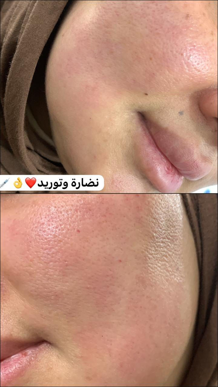 اصيل بيوتي للتجميل وليزر
رؤى الجبوري 

شارع الصالونات مجاور شركة اسيا سيل

نفس عماره باور جم طابق ثاني❤️

***********

لحگوا عرووض ونتائج👌💉
