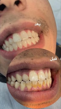 تنظيف أسنان • إزالة كلس • مجاني