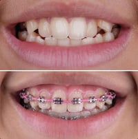 🦷 التقويم في عيادة دكتورة رسل الشمري🦷 احصل على ابتسامة مثالية مع أحدث ...