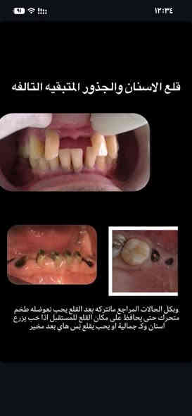 علاج جميع مشاكل الاسنان #مجاناً 

باستخدام احدث الاجهزه وبأشراف دكاتره اختصاص 

للحجز والاستفسار التواصل ع الواتساب ***********

العنوان /الحلة -شارع 40 - مجاور صيدليه سلامتك اولا - فندق الحياة سابقا
