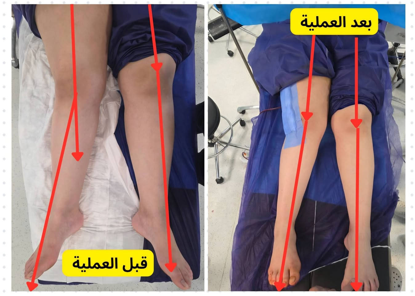 بفضل الله تعالى، عملية مميزة لتعديل انحراف الساق، تمت العملية بدقة عالية عن طريق قص وتعديل عظم الفخذ بعد اخذ القياسات المطلوبة. نتمنى الشفاء العاجل للجميع #د.مثنى سالم #اخصائي جراحة العظام والكسور والمفاصل #جلولاء مجاور المصرف القديم للحجز والاستفسار ***********
