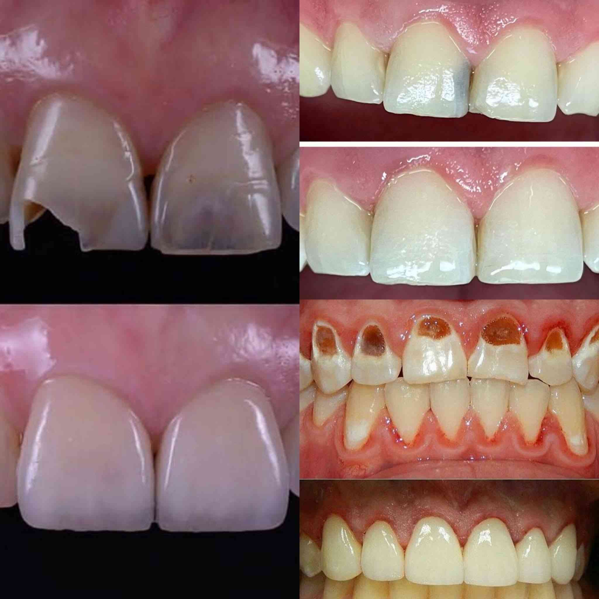 السلام عليكم🦷
⬅️ يتوفر حشـوات ضوئية دائمية (تجميلية)
⬅️ تنـظيف الاسنان وازالة التكلسات والتصبغات
⬅️ قلـع الأسنان و بقايا الجذور التالفة 
العلاج آمن و مجاني و تحت اشراف اطباء مختصين✔️
اي شخص عنده هاي الحالات الي بالصور ويحتاج علاج لاسنانة يتواصل ***********  واتساب 
حتى اثبت موعد للعلاج
‎الموقع: بغداد الكرادة ساحة الأندلس عيادات جامعة الاسراء
