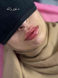 د نور رائد • رسم شفة • عيادة بيرلي نبتون