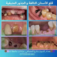 قلع أسنان • قلع جذور • الدورة شارع المصافي