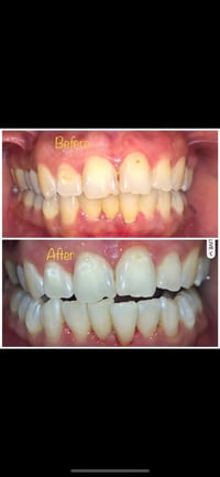 ودّع اصفرار الأسنان💛💛 جلسة تبييض بالليزر 🔹 آمن 🔹 سريع 🔹 نتيجة فورية 📍 ...
