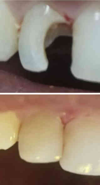 اعلااان🏅

السلام عليكم
بعد الانقطاع بسبب عطله الانتخابات
عياداتنه رجعت من جديد 
جاهزين لارجاع ابتساماتكم  والضحكه الحلوه على وجوهكم الجميله

وبشكل مجااااني

شنو الحالات الي نشتغلها؟
١-حشوات تجميليه ضوئيه
٢-تنظيف وازاله التكلسات والتصبغات
٣-قلع الاسنان التالفه او الجذور المتبقيه
٤-تعويض الاسنان المفقوده بطقم

موقعنا: كربلاء - حي الموظفين- خلف مشفى الولاده- عيادات جامعه كربلاء

زين انتو طلاب وجاي تطبقون بينه وتتعلمون مو صح!!

هاي جانب من شغل طلابنا شوف واحكم بنفسك.

للتواصل:***********
