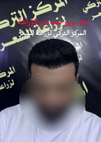 اقساط شهريه بدون مقدمه على مدى ١٠ اشهر  🇹🇷كادر تركي مختص بزراعة الشعر ...