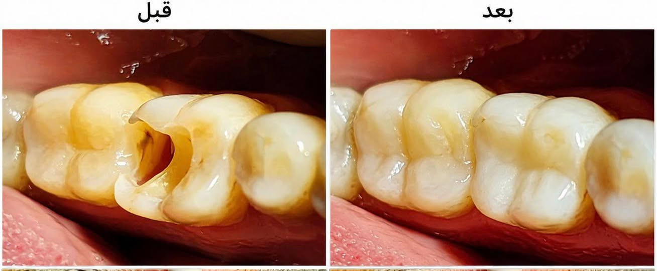 أعتذر منك على اللبس، تم التعديل بالكامل ليصبح البوست مخصصاً للحشوات التجميلية بمادة **الكومبوزيت (Composite)** الممتازة:
## 🦷 ابتسامة مكتملة وطبيعية.. لأن تفاصيلك تهمنا! ✨
في عيادة **الدكتور محمد خداداد**، نؤمن أن الابتسامة الجميلة تبدأ من صحة الأسنان ودقة الاختيار. نتشرف بمشاركتكم تفاصيل إحدى حالاتنا المتميزة التي أشرفت عليها دكتورتنا المبدعة:
 * **الخطة العلاجية (بإشراف الدكتور محمد خداداد وعلى يد الدكتورة الشاطرة _ فاطمة أحمد):**
   تم تقديم علاج متكامل يعتمد على مجموعة من **الحشوات التجميلية والوظيفية**، مع التركيز الكامل على **إرجاع الإطباق الصحيح والسليم للسن**؛ لضمان كفاءة المضغ وتفادي أي آثار جانبية مستقبلياً.
 * **المادة المستخدمة:** أفضل وأجود أنواع **الكومبوزيت (Composite)**، المعروف بقوته العالية ومحاكاته الرائعة للون السن الطبيعي.
 * **النتيجة:** تناسق تام وانسيابي للون الحشوة مع بقية الأسنان، ليعود المظهر الجمالي والوظيفة الحيوية للسن بأفضل شكل ممكن ودون أي اختلاف ملحوظ.
> 💡 **لماذا حشوات الكومبوزيت التجميلية؟** لأنها تندمج مع أنسجة السن بدقة متناهية وتمنحك مظهراً طبيعياً وقوة تدوم طويلًا.
> 
### 📍 عيادة الدكتور محمد خداداد
نستقبلكم بكل حب لتقديم أفضل خدمات طب وتجميل الأسنان:
 * 🦷 **حشوات الأسنان** (العلاجية والتجميلية والوظيفية)
 * ✨ **تنظيف وتبييض الأسنان** بأحدث تقنيات الليزر
 * 👑 **تغليف الأسنان** (التعويضية والتجميلية)
 * 🌱 **زراعة الأسنان** بأحدث التقنيات
 * 🩺 **قلع الأسنان** والجراحة المبسطة
### 📞 للحجز والاستفسار:
 * **رقم الهاتف:** ***********
 * **العنوان:** خانقين / تولةفروش / مقابل مسبح مرواري
#طب_أسنان #حشوات_تجميلية #كومبوزيت #تجميل_الأسنان #ابتسامة_طبيعية #خانقين
