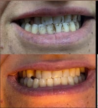 تنظيف تبييض اسنان • دكتوره زهراء • جبله شارع الاطباء