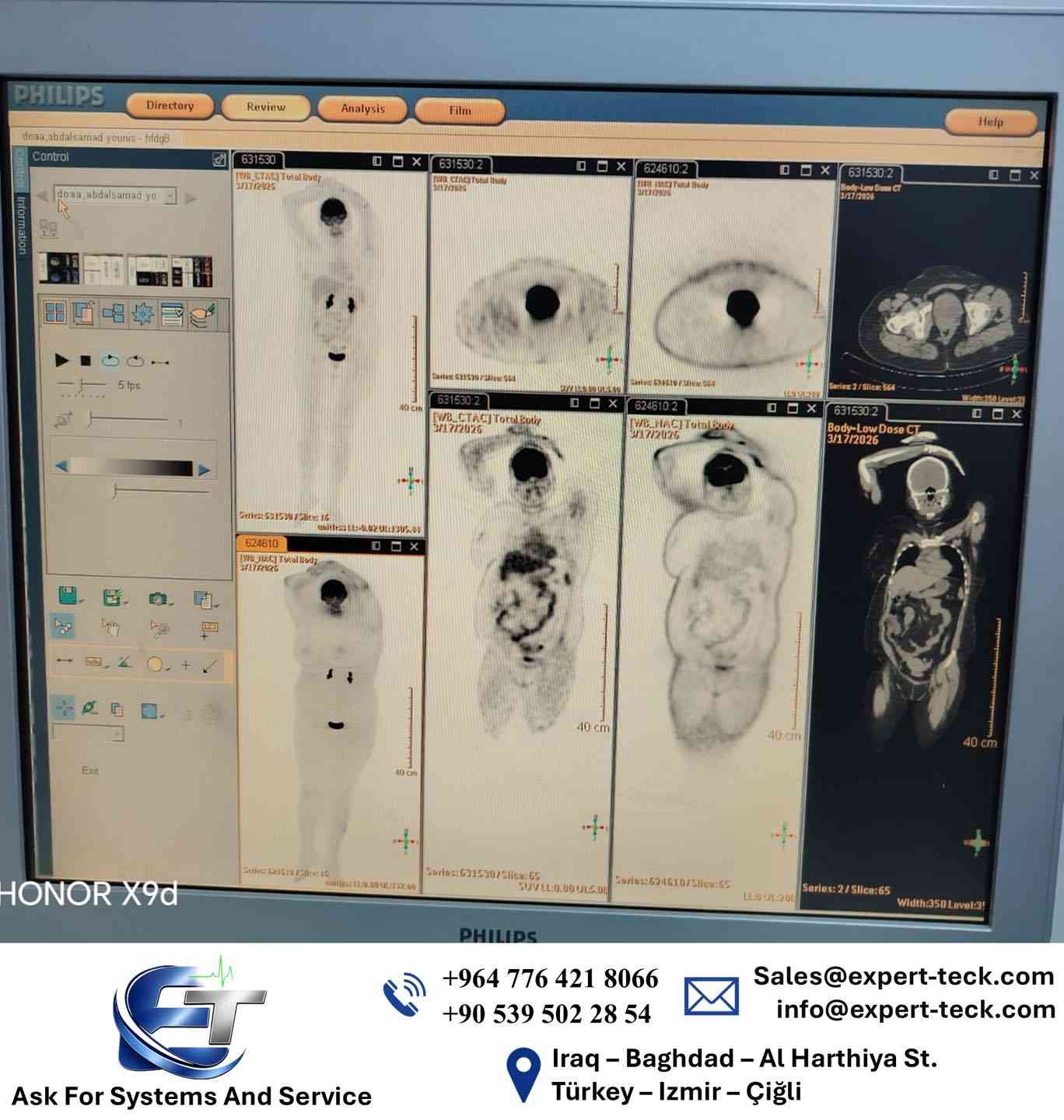 بسرعة استجابة ودقة في التشخيص تمكن كادرنا الهندسي المختص والحمد لله من تصليج جهاز ال 
Petct philips
في مركز الحدباء التخصصي / الموصل وارجاعه الى العمل.
شركتنا متخصصة بتجهيز وتنصيب وصيانة الاجهزة الطبية مع وجود كوادر تدريب مختصة

📞 للاستفسار عن عروض الشركة الاتصال على الأرقام التالية:

📍 بغداد: ***********

📍 تركيا: 00905397065915

✉ البريد الإلكتروني: sales@expert-teck.com

او زيارة مقر الشركة / بغداد - الحارثية
