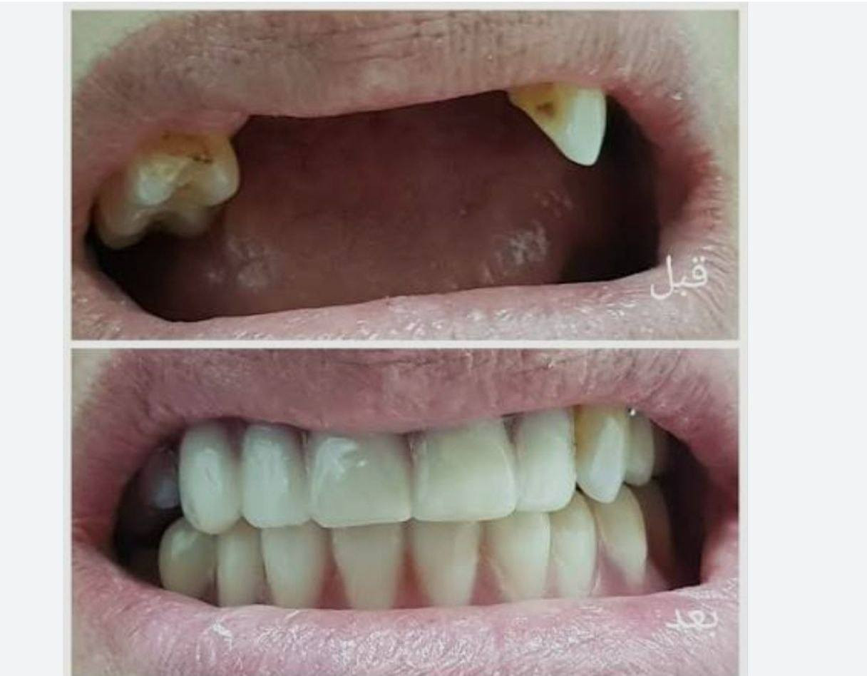 السلام عليكم الي يحتاج تخم اسنان نقدمه مجاني تحت اشراف دكاترة مختصين استغلو الفرصة خلال الكورس الثاني حتة نكمل الجلسات قبل رمضان و قبل لا تخلص السنة الي يكدر يجي لجامعة المشرق بشارع المطار يتواصل وياي
و نوفر ايضا قلع حشوات تجميلية 
تواصلت على الرقم واتساب *********** او معرف @NbooHas

