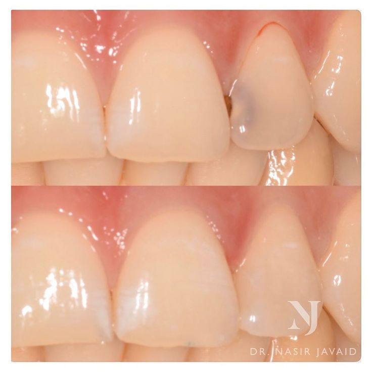 ‏‪تعلن جامعة اهل البيت عن استقبال الحالات التاليه 📌مجانا وباشراف الاطباء الاختصاص:
🛑قلع الاسنان والجذور التالفه 
🛑تنضيف الاسنان من التصبغات والتكلسات 
🛑حشوات تجميليه  للاسنان الاماميه المكسورة أو تسوس بسيط، للحجز  اترك تعليق وسيتم الرد عليك او مراسله على الرقم 👇🏻
واتساب :📞‏‪***********‬‏
📍موقع الجامعه كربلاء -شارع الحر الصغير
