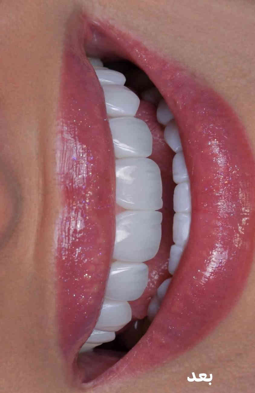 قبل وبعد… فرق واضح 😍
جودة عالية ✅
طبيعي 100% ✅
ابتسامة تدوم ✅

عيادة سومر خيارك الافضل ✨ 
الدكتور موسى محمود الكعبي / مجمع سومر الطابق الثاني 
📞 ***********
