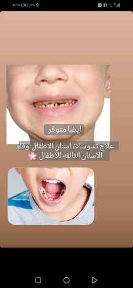 السلام عليكم 
منو محتاج 
قلع 
عيادة اطفال: (قلع ،حشوات ،تنظيف الاسنان) 
تقويم 
حشوات تجميلية ومعدنية
تعويض الاسنان المفقودة بطقم متحرك
فاقد اسنان فك كامل او احدى الفكين 
تنظيف الاسنان من التكلسات
يتواصل وياي 
العمل مجاني بغداد الكراده شارع 52عيادات جامعة ارووك ***********وتساب
