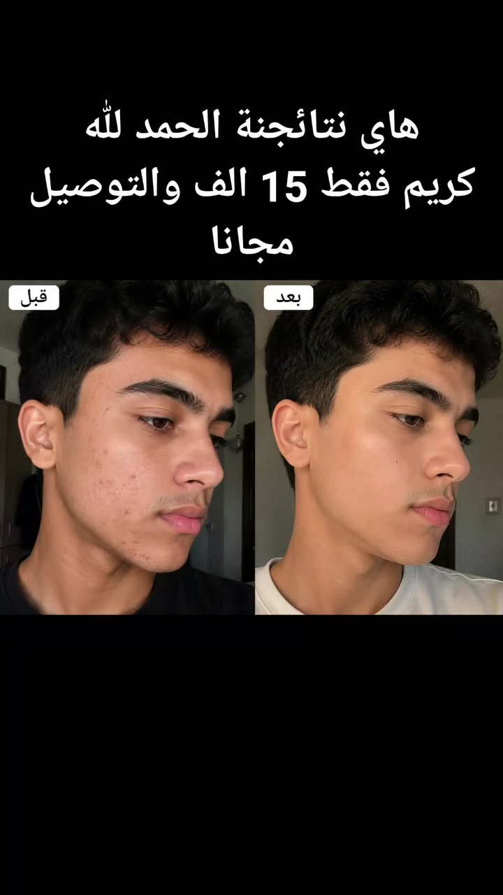 مرحبا 🥰 السعر ب15 الف فقط والتوصيل مجانا 
عرض خاص
والقطعتين ب27 الف
+ الصابون 
والتوصيل مجانا 🥰 والمحافظات السعر 17 الف والتوصيل مجانا
عرض خاص


**إذا كنت صاحب هذا الإعلان وتريد حذفه لأي سبب، رجاءا أرسل رسالة إلى الدعم الفني**