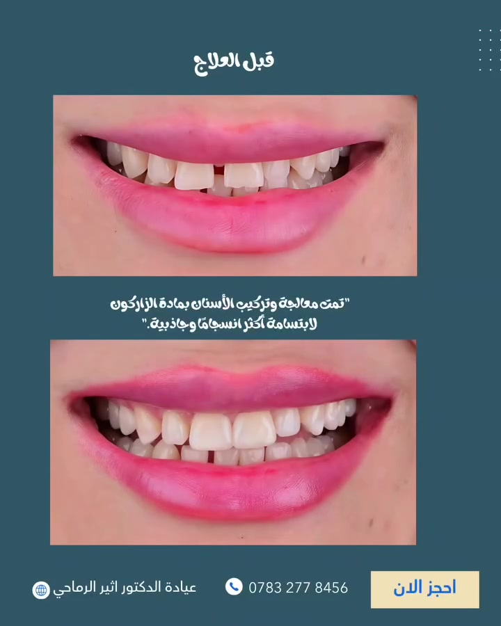 تم استعادة جمال الابتسامة بتركيبات الزاركون 
  لتمنح مظهرًا طبيعيًا وانسجامًا مثاليًا.😍

 
 (عيادة الدكتور أثير حليم الرماحي) 

☎️ للحجز والاستفسار ***********
او مراسلة الصفحه 

📍 الموقع: 
الديوانية- قضاء عفك/شارع الأطباء قرب صيدلية أكرم البديري بناية الدكتورة مروة حمود التميمي الطابق الثاني

#ابتسامتك_تستحق_الأفضل👌❤️
#اكسبلورexplore #حشوات_تجميلية_حشوات_جذور_تركيب_اسنان_ثابتة_ومتحركة_تبييض_اسنان_بالليزر_ابتسامة_المشاهير #قضاء_عفك #دكتور_اثير_الرماحي
