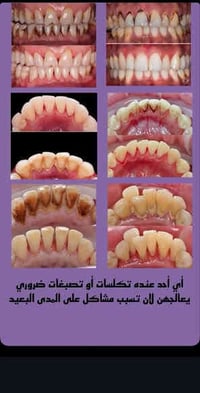 قلع أسنان • تنظيف أسنان • حشوات تجميلية