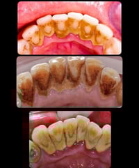 علاج اسنان • مجانا • جامعة القادسية