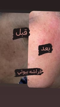 د ساره • تفتيح البشرة • بدون حقن