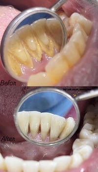 تنظيف أسنان • علاج مجاني • جامعة بلاد الرافدين
