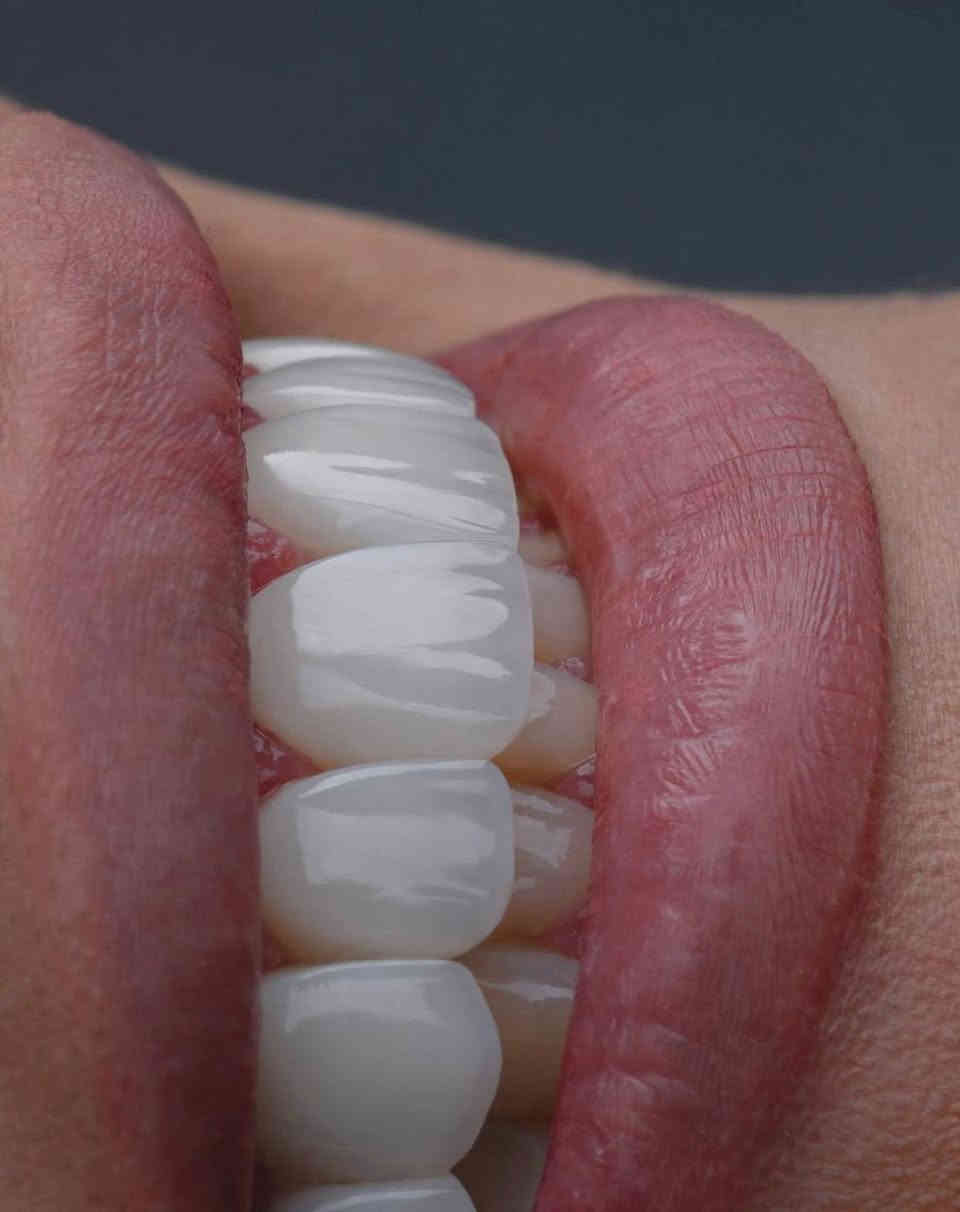 قبل وبعد… فرق واضح 😍
جودة عالية ✅
طبيعي 100% ✅
ابتسامة تدوم ✅

عيادة سومر خيارك الافضل ✨ 
الدكتور موسى محمود الكعبي / مجمع سومر الطابق الثاني 
📞 ***********
