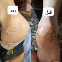 علاج الامراض الجلدية في عيادتنا 💞 شكرا مراجعتنا على مشاركه الصوره 🌹🌹🌹 ...